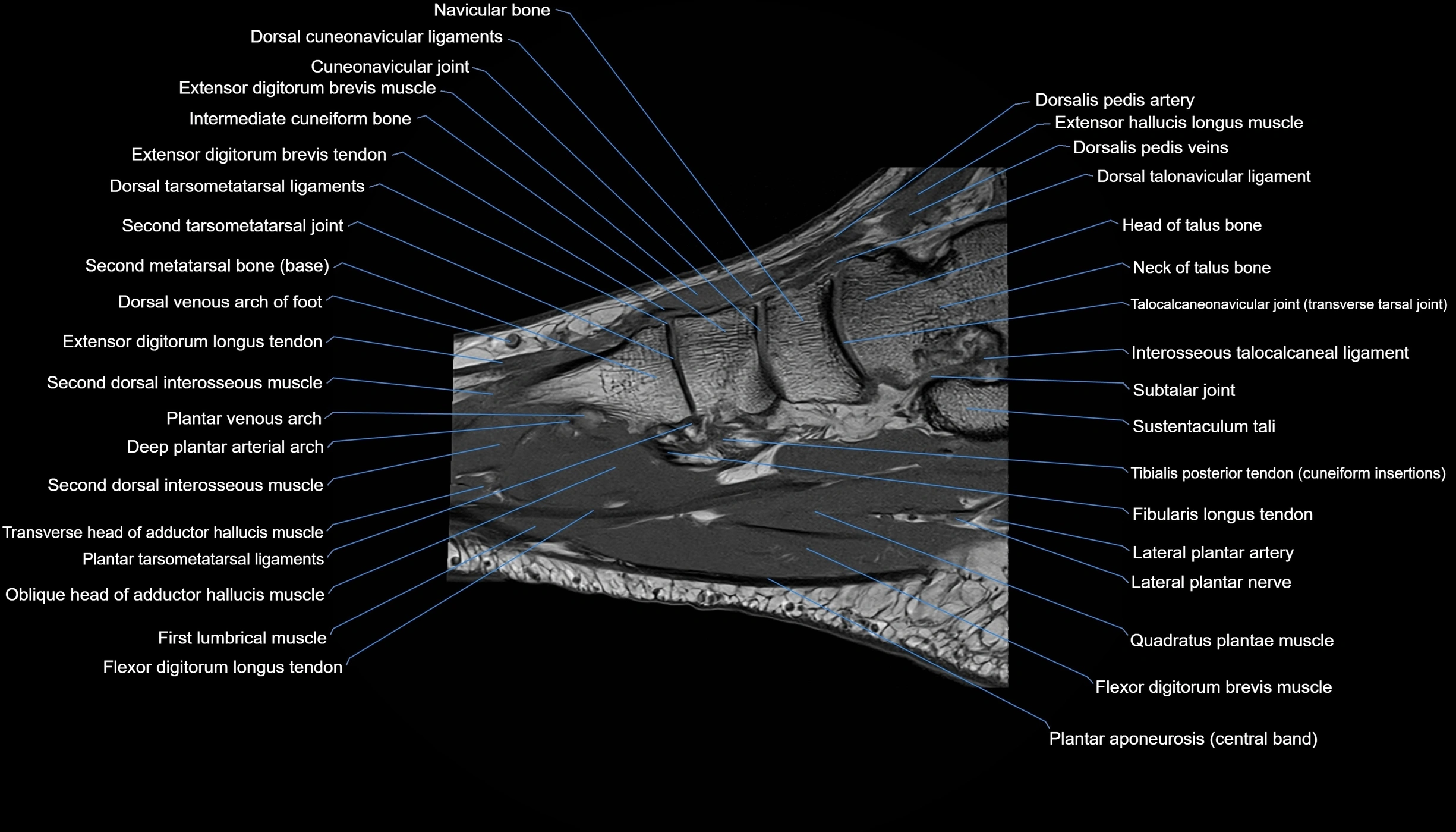 MRI mid foot sagittal cross sectional anatomy 3T  radiology  image-img-00001-00024.webp